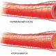 Асимметрия кровотока по позвоночным артериям или синдром позвоночной артерии Атеросклероз позвоночных артерий и сосудов головного мозга